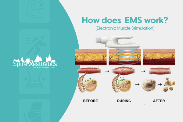 EMS treatment for post pregnancy weight loss treatment Chatham