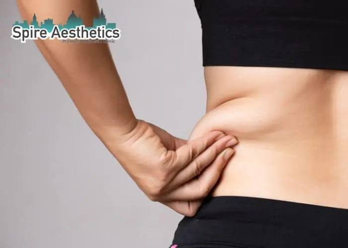 Image of woman pinching fat on their hips Chatham. Fat Freezing treatment