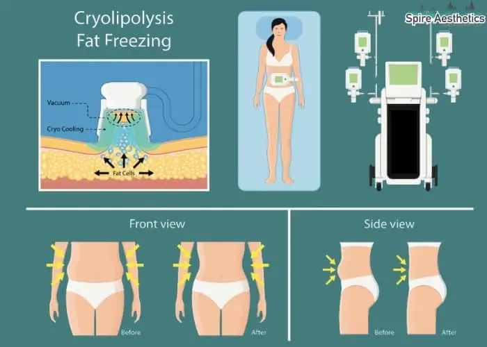 Fat freezing treatment Chatham benefits for competitions to remove stubborn fat deposits.