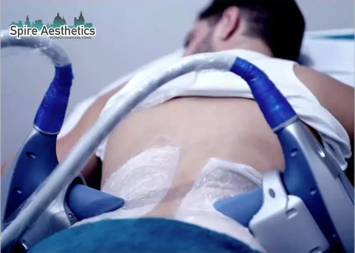 Man having fat freezing treatment done on love handles before a competitions Chatham to create a sculpted look.