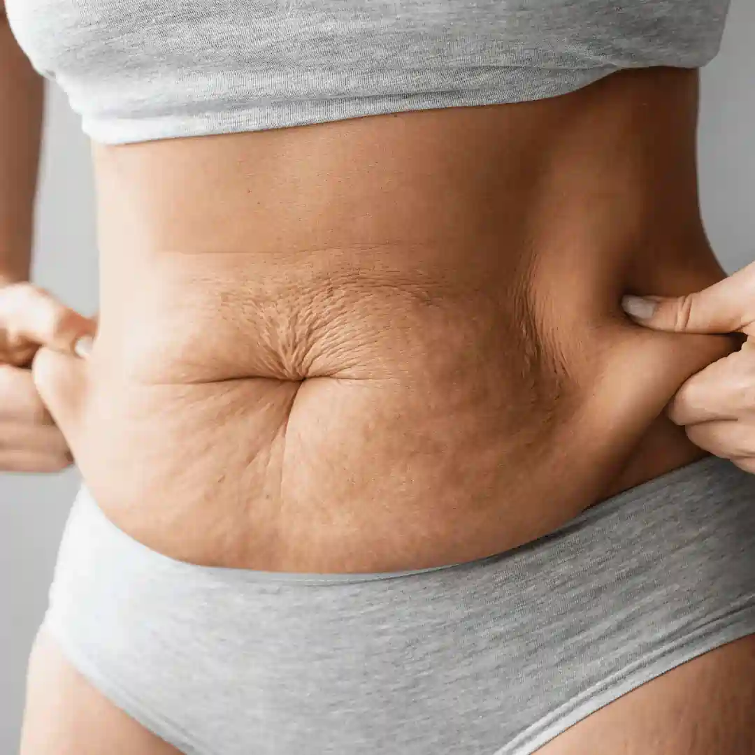 Is It Normal to Have Loose Skin After Pregnancy Chatham?