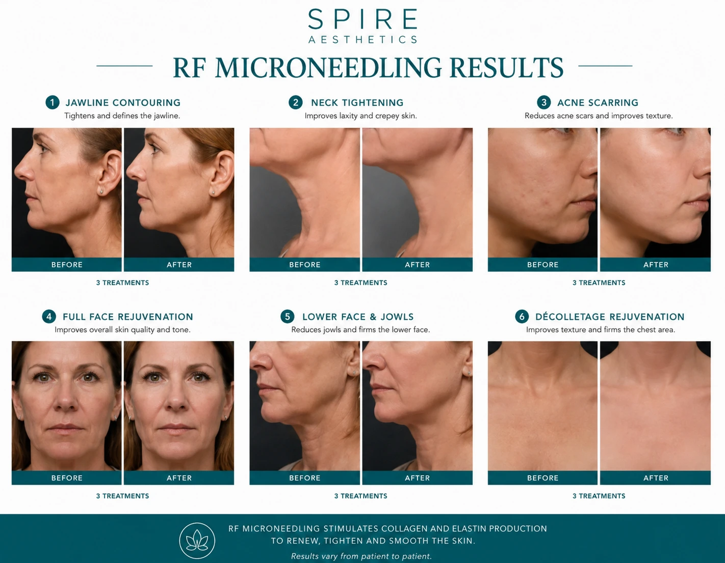 RF Microneedling Skin tightening Chatham results