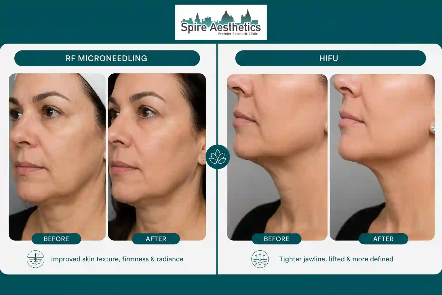 Can RF Microneedling and HIFU Be Combined Chatham?